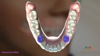 Orthodontic Treatment for Underbite or Crossbite - Removing Lower 1st Premolars