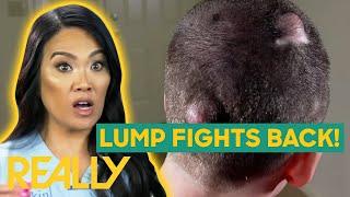 Dr. Lee Gets Sprayed By A Lump During Surgery | Dr. Pimple Popper