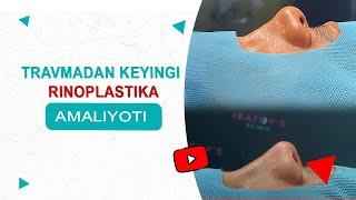 Travmadan keyingi rinoplastika amaliyoti