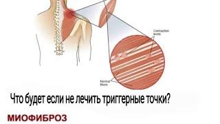 ТАК ЗВУЧИТ ФИБРОЗ МЫШЦ НОГ ЛЕЧЕНИЕ ХРОНИЧЕСКОЙ БОЛИ В НОГАХ | МИОПРЕССУРА | ЛЕЧЕБНЫЙ МАССАЖ ТРИГГЕРЫ