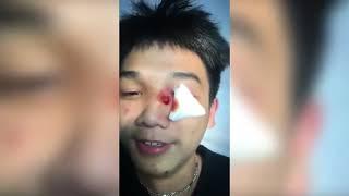 Popping huge blackheads and Pimple Popping