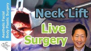 Live Plastic Surgery Video of a Neck Lift | Platysmaplasty by Dr. Philip Young Bellevue Seattle