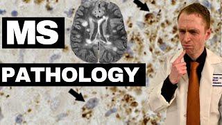 Multiple Sclerosis Pathology