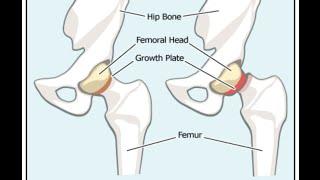 Slipped Capital Femoral Epiphysis (SCFE)