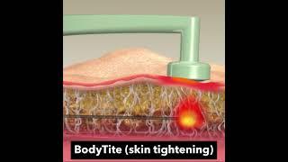 Reno NV BodyTite Flank Liposuction and Skin Tightening Under Local Anesthesia | Dr. Erez Dayan