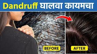 कोंढा कायमचा घालवतील 'हे' Shampoo | Get Rid Of Dandruff In Winters | Haircare Tips | MA2