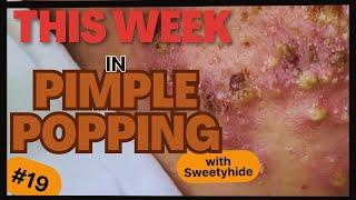 This Week in PIMPLE POPPING #19