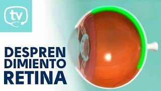 El desprendimiento de retina