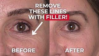 Safe Tear Trough Injection Tutorial with Dermal Filler.