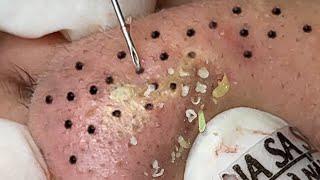 Blackhead Removal With Sac Dep Spa @10006988