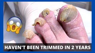 CUTTING AND GRINDING CRAZY TOENAILS - Toe Fungus Journey