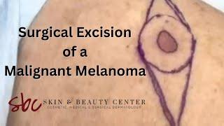 Surgical Excision of a Malignant Melanoma