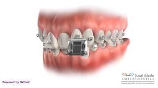 Damon Q Bracket -Braces