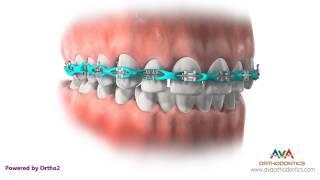 Space Closure by Power Chain - Orthodontic Treatment