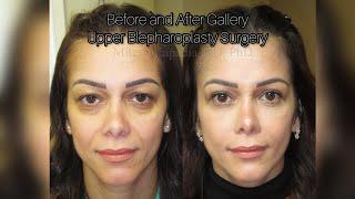 Before and After Gallery - Cosmetic Upper Eyelid Surgery