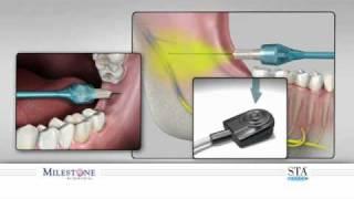 Znieczulenie przewodowe - Mandibular Block.wmv