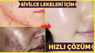 BEBEK GİBİ BİR CİLT İÇİN 3 AŞAMALI ASPİRİN MASKESİ