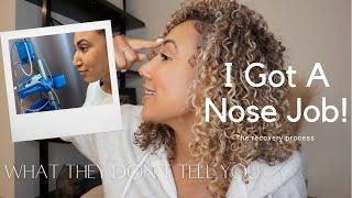 What They Don't Tell You About Rhinoplasty | My Experience & Recovery With My Nose Job