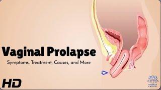 Vaginal Prolapse 101: What Every Woman Should Know