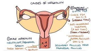Understanding Infertility Causes and Investigations