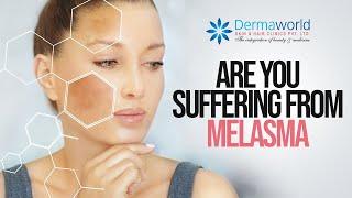 Suffering from Melasma, Here's the solution!