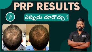 #AskDrJohnWatts | PRP RESULTS ఎప్పుడు చూడొచ్చు ? | Hair Specialist Explains