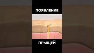 Как Появляются Прыщи  #Шок #Ого #Прыщи  Появление Прыщей На Лице у Человека  Как Избавиться ??? 