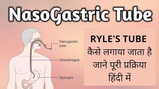 Ryle’s Tube | Nasogastric Tube – Nursing Assistant Course