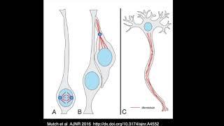 Tubulinopathies in 5 minutes