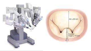 Advantages of Robotic Mitral Valve Repair with Dr. Vinay Badhwar (WVU Heart & Vascular Institute)