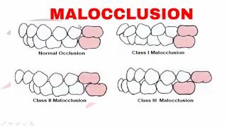 Malocclusion : Part I