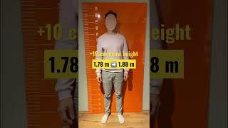 +10cm more height with limb lengthening surgery #limblengthening #gettaller #beinverlängerung #short