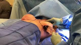 Breast Implant Exchange - Breast Augmentation Redo at Azul Plastic Surgery Sugar Land Houston TX