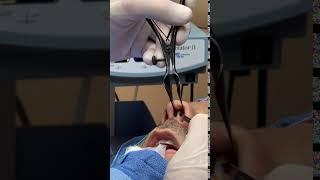 Septoplasty - Septal Incision