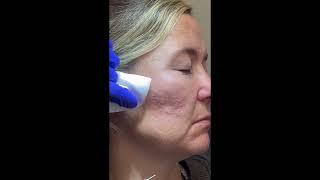 Bellafill, the longest lasting filler, for acne scars with Lawrence Janowski, MD