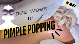 This Week in PIMPLE POPPING #26