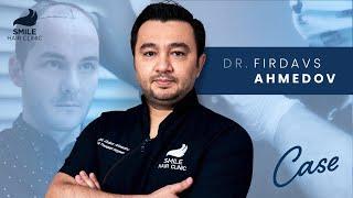 Case Studies with Dr. Firdavs Ahmedov | 4000 Grafts & 12 Month Results | Smile Hair Clinic