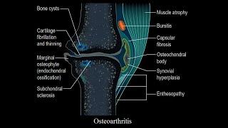 Exploring Osteoarthritis.