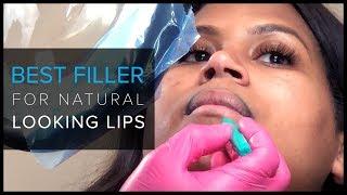 Natural-Looking Lip Injections in San Francisco