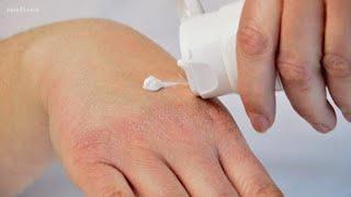 Understanding what causes eczema