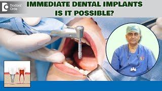 Immediate Dental Implants Success Rate | Same Day Implants-Dr.Manesh Chandra Sharma |Doctors' Circle