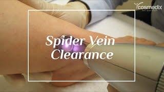 Spider Vein Clearance