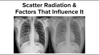 Scatter Radiation & Factors That Influence