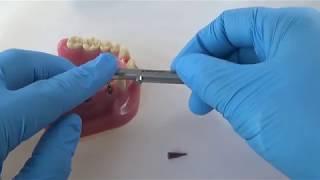 How to Torque a Final Abutment Using the Straumann® Torque Wrench