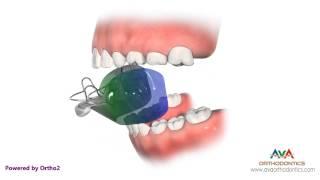 Orthodontic Treatment for Overjet (Overbite) - Bionator Appliance