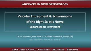 Vascular Entrapment & Schwannoma of the Right Sciatic Nerve