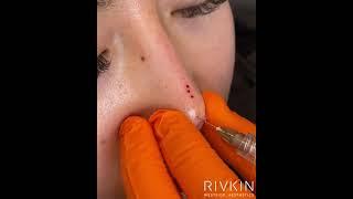 5 minute nose job by Dr. Rivkin