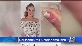 Woman Develops Melanoma After Receiving Gel Manicures