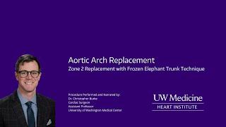 Aortic Arch Replacement of Zone 2 w/ Frozen Elephant Trunk Technique (FET)