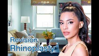 Revision Rhinoplasty Experience by Indy Johnson